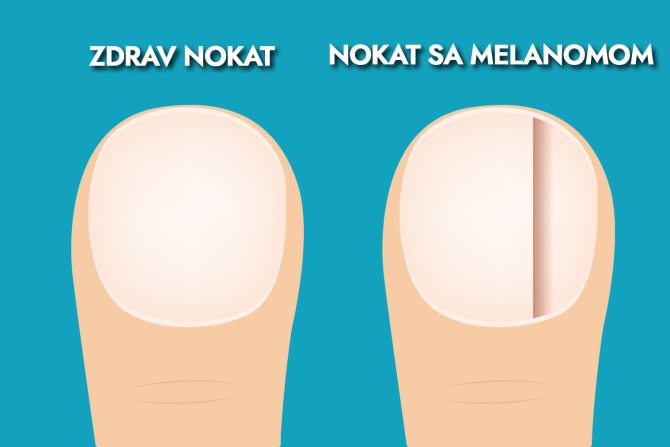 Subungvalni melanom nokta