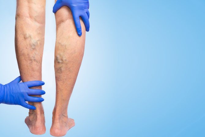 hronična venska insuficijencija