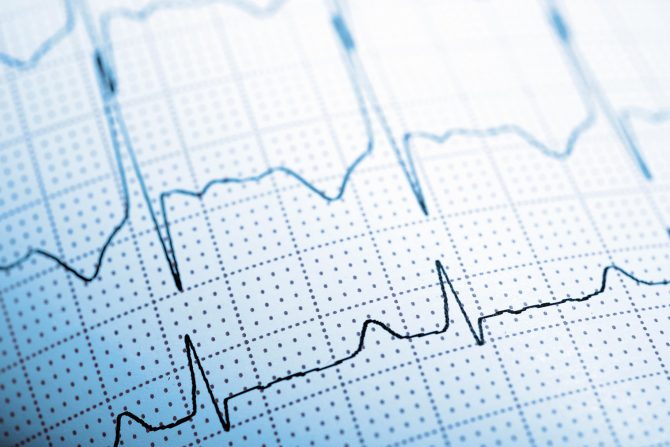 ubrzani rad srca
