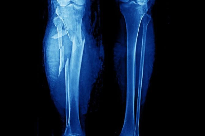 Fraktura višestruka kompleksna