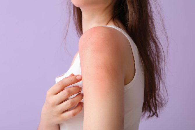 Ujedi insekata i alergija na sunce