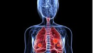 Na koje organe se širi metastatski rak pluća i kakve su prognoze sa metastazama na mozgu