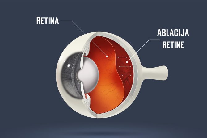 Ablacija retine