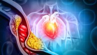 „Tihi ubica“ u arterijama: Može li se plak zaista smanjiti i tako sprečiti infarkt?