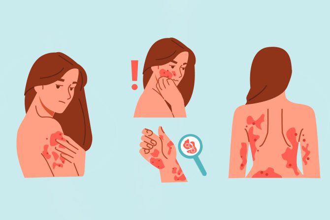 početak psorijaze simptomi