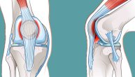 Da li ćemo dobiti osteoartritis ili oštetiti hrskavicu ako nam „krckaju kolena”