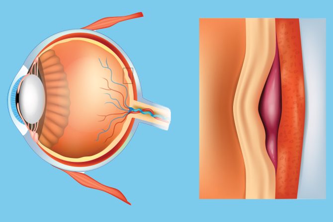 Makularna degeneracija
