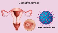 Na koje sve načine može da se prenese genitalni herpes?