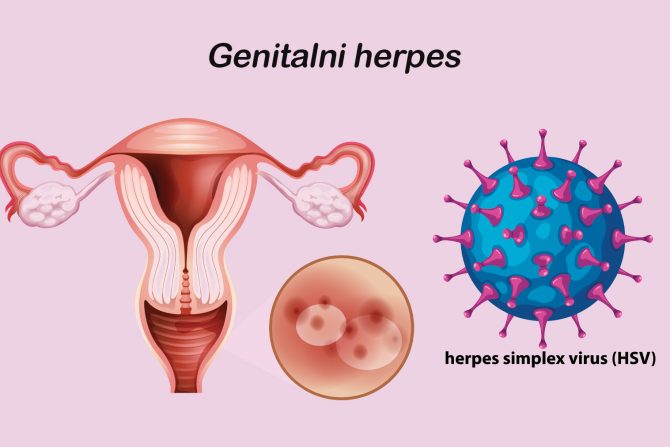 genitalni herpes