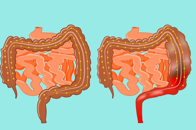 Hiršprungova bolest