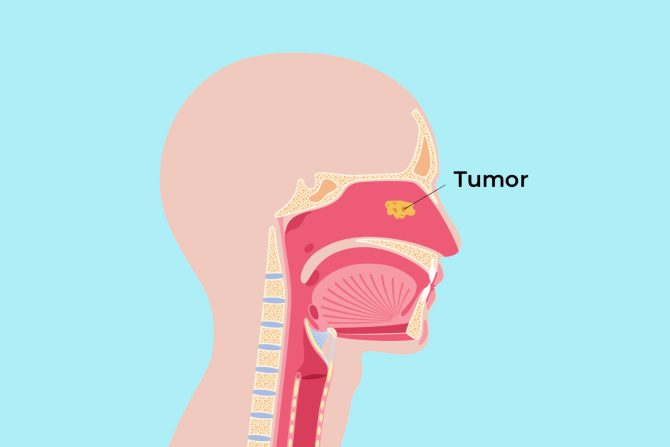 sinonazalni karcinom