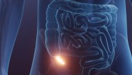 Upala slepog creva ne leči se uvek operacijom, kada su dovoljni antibiotici i da li su oni trajno rešenje