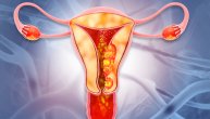 Šta je najvažnije za lečenje raka endometrijuma, sve češćeg kod mlađih žena