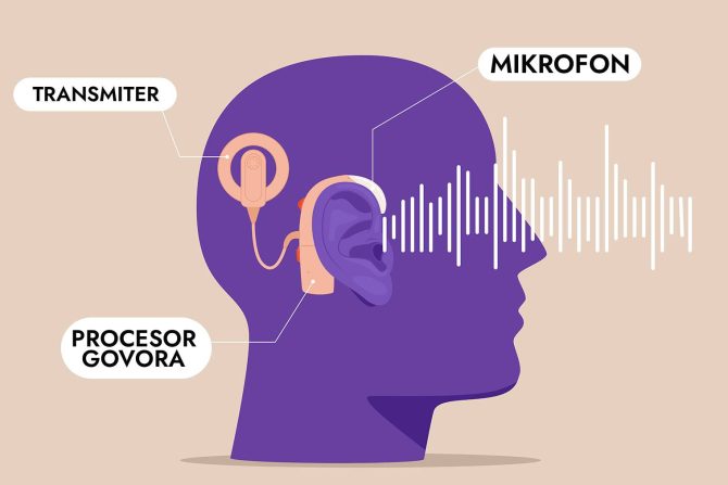 Efikasnost kohlearnih implantata