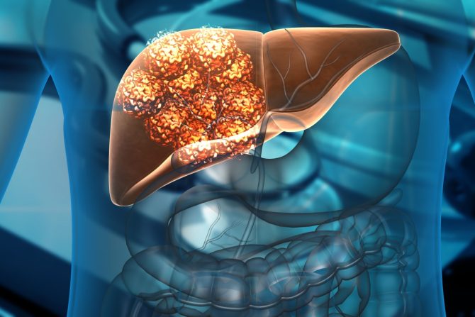 rak jetre proširi na kosti