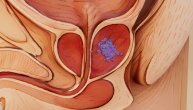 Kombinacija lekova smanjuje rizik od smrti kod uznapredovalog raka prostate za 40 odsto, pokazuje kliničko ispitivanje