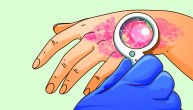 Upaljena, crvena koža koja svrbi, nije uvek simptom psorijaze, postoji 5 sličnih stanja