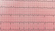Atrijalna fibrilacija može da se završi šlogom, a često se meša sa anksioznošću i panikom, kaže kardiolog