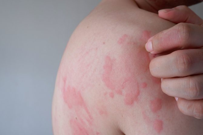 stresna urtikarija