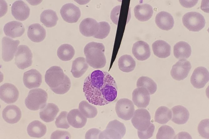 povišen nivo granulocita