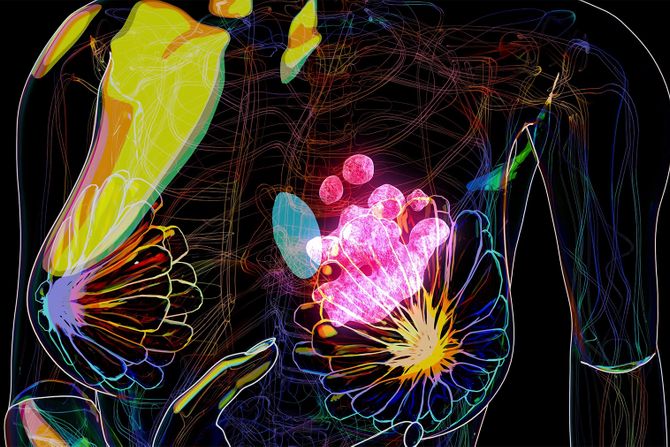 Zračenje nije potrebno svakoj ženi koja ima rak dojke