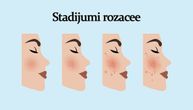 Rozacea se razlikuje u odnosu na faze i stadijume, od čega zavisi lečenje i nega