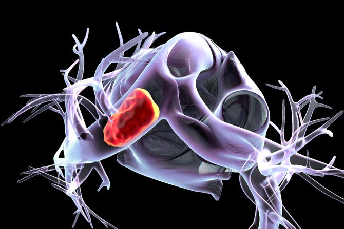 Krvni ugrušak najčešće do pluća putuje iz nogu