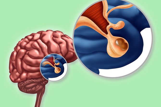 Tumori hipofize u najvećem broju slučajeva su benigni