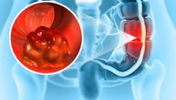 Gastroenterolog upozorava: obratite pažnju na ova četiri rana simptoma raka debelog creva kod mladih