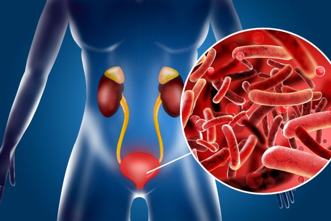 upala mokraćne bešike, cistis