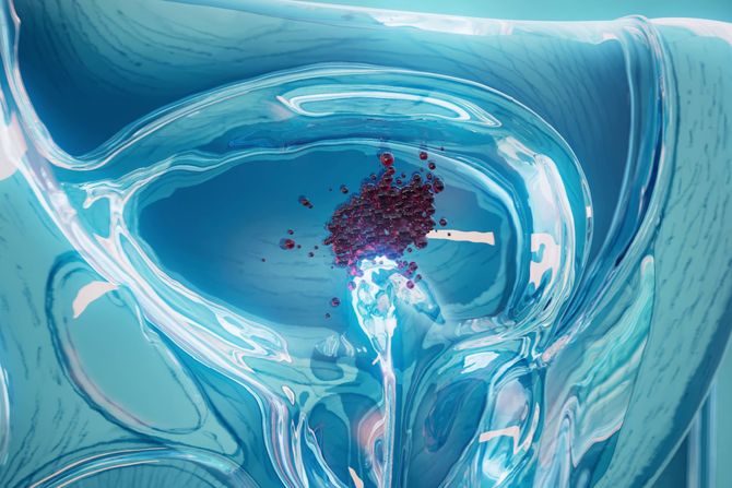 Karcinom mokraćne bešike nije više samo bolest starih