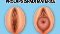 Spad ili prolaps materice otežava varenje i izaziva urinarne probleme: Ugrožava li plodnost?