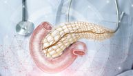 Šta je IPMN - intraduktalna papilarna mucinozna neoplazija na pankreasu?