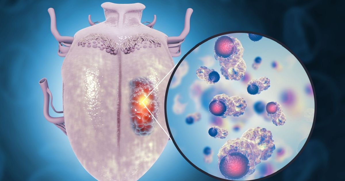 Can lymphoma cause head and neck cancer: Doctors reveal what the latest research says