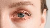 Alergijski konjunktivitis može da izazove opasni keratokonus - slabljenje vida i deformaciju rožnjače