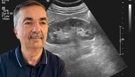 Koliko su opasne bubrežne ciste, mogu li da puknu, pređu u rak, objašnjava prof. dr Dragan Jovanović