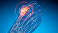 Ortopedski hirurg razotkriva mitove o čukljevima i mogućnostima lečenja, da li je obuća krivac?