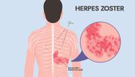 Herpes zoster praćen nekad nesnosnim bolom je u porastu, pacijenti su i mlade osobe, zašto se virus budi