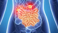 Do 2050. godine rak gastrointestinalnog trakta imaće dvostruko više ljudi, upozoravaju stručnjaci