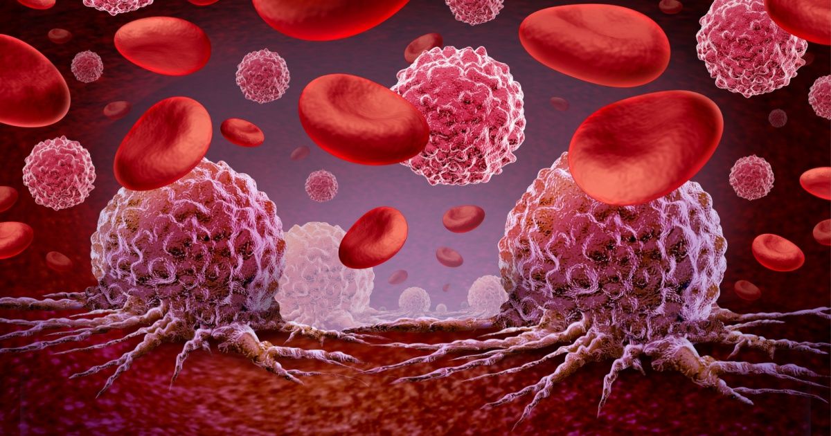 Aggressive Leukemia Could Be Treated With New Combined Therapy, German Scientists Discover