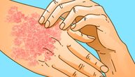 Odobren prvi oralni lek za psorijazu. Konačno olakšanje za milione ljudi koji pate od ovog stanja