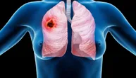 Zašto sve više žena dobija rak pluća i koji je razlog za bolju prognozu u odnosu na muškarce