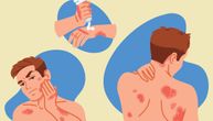 Atopijski dermatitis krade san i vodi do značajnih „rupa” u pamćenju, rezultat je novog istraživanja