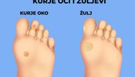 8 razloga zbog kojih nastaje kurje oko i žulj