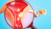 Šta endometrioza znači za trudnoću, imaju li bebe rizik od kongenitalnih anomalija