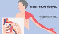 Sindrom torakalnog otvora pogađa gornji deo tela, obično na jednoj strani tela