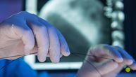 Ugrađen vam je stent? Jedna navika za stolom mogla bi da smanji rizik od novog infarkta