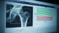 Hormonska terapija u menopauzi smanjuje rizik od niske gustine kostiju za 69 odsto, rezultat je nove studije