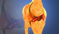 Povreda ligamenata kolena nekada daje simptome koji ne smeju da se ignorišu: Kada je operacija neophodna?
