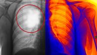 Pluća nemaju receptore za bol. Tumor unutar ovog organa može da raste, a da osoba ne oseti apsolutno ništa